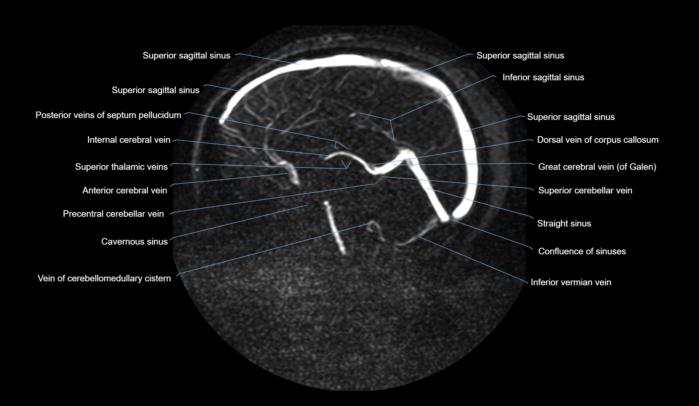 MRV brain sagittal anatomy 3T MRI labelledimages -00043.webp